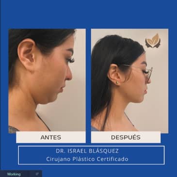 Slider image (8) Dr. Israel Villalobos - Plastic Surgery in Tijuana Mexico